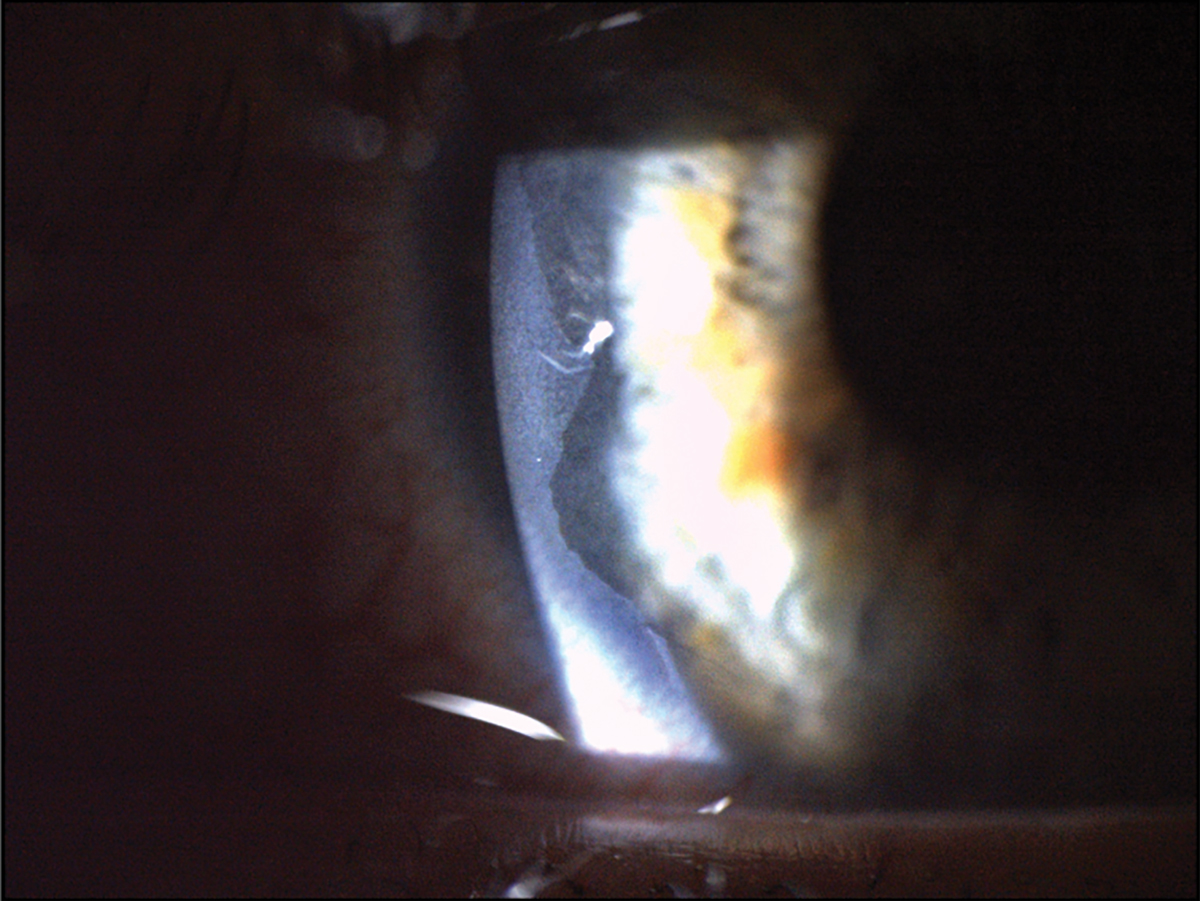 Fig. 3. This patient had a severe chemical burn secondary to exposure from a basic commercial water treatment product. This led to significant epithelial loss that can be seen at the temporal aspect of the cornea near the limbus.