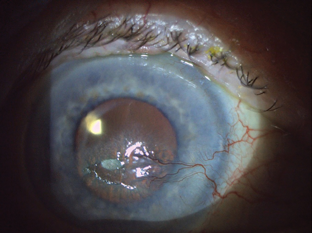 Fig. 5. This patient has a large area of epithelial disruption. There is a central epithelial defect and plaque, along with nasal neovascularization secondary to previous history of herpes zoster ophthalmicus keratouveitis and post-herpetic trigeminal neuralgia.